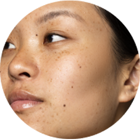 Facial - Pigmentation
