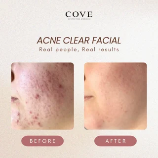Image 45: Incredible transformation after just 5 sessions! Our client was struggling with severe active acne, but with our personalized acne facials and skincare routine, her skin has made remarkable progress. Look at the difference! ✨ Book your appointment today and let us help you achieve your skin goals. Wheelock ☎️ 6734 6431/8299 2920 (Call/WhatsApp) 📍 Wheelock Place #04-07B Guoco Tower ☎️ 8339 3518 (Call/Whatsapp) 📍 7 Wallich Street, #B1-14, Singapore 078884 #acnefree #acnetreatment #acnefacial #acnespecialist #facialtreatment #acnetransformation #facialsingapore